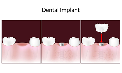 Rochester Hills Dental Implants